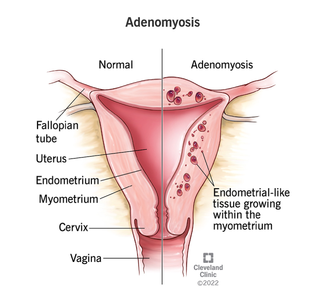 adenomyosis