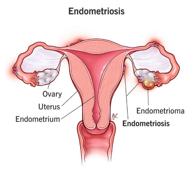 endometriosis