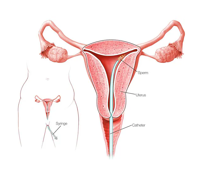 iui