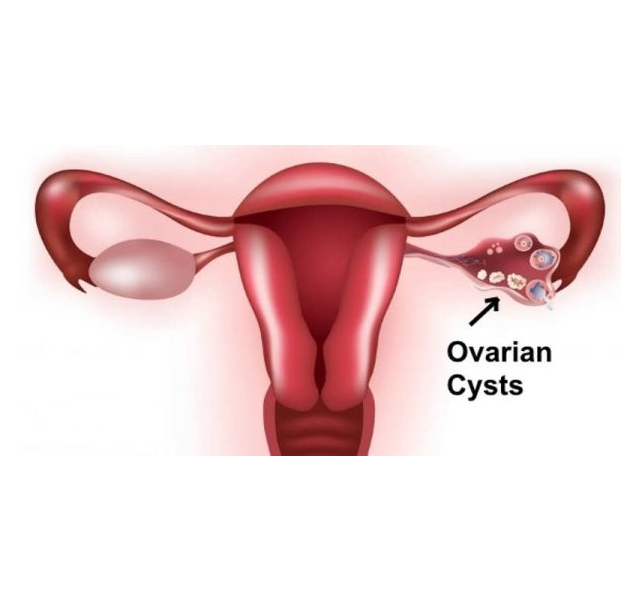 ovarian cysts